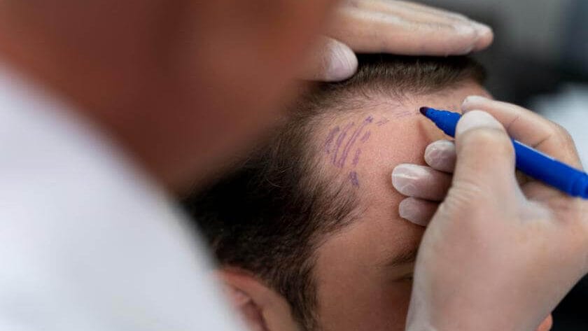 Hairline Surgery